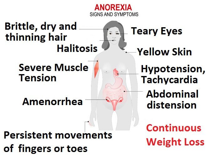 anorexia-symptoms.jpg