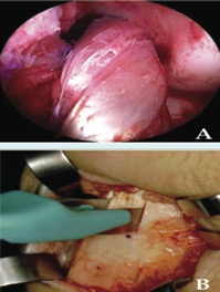 **Figure X:** Demonstrates the extraction and retrieval of an autograft sample. 
 (Source: Mayo Foundation for Medical Education and Research, 2016)