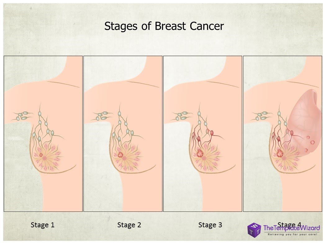 breastcancerstages.jpg