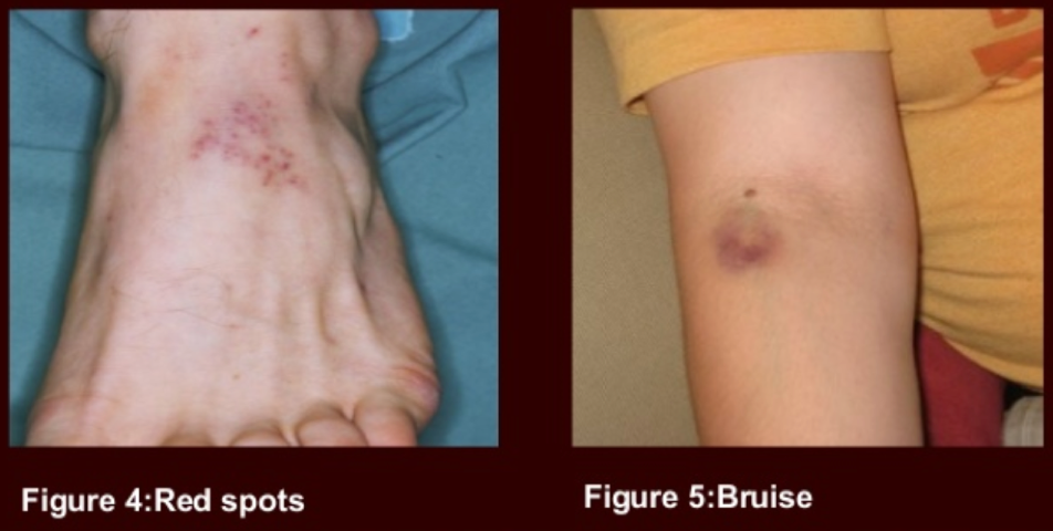 bruise_clinical.png
