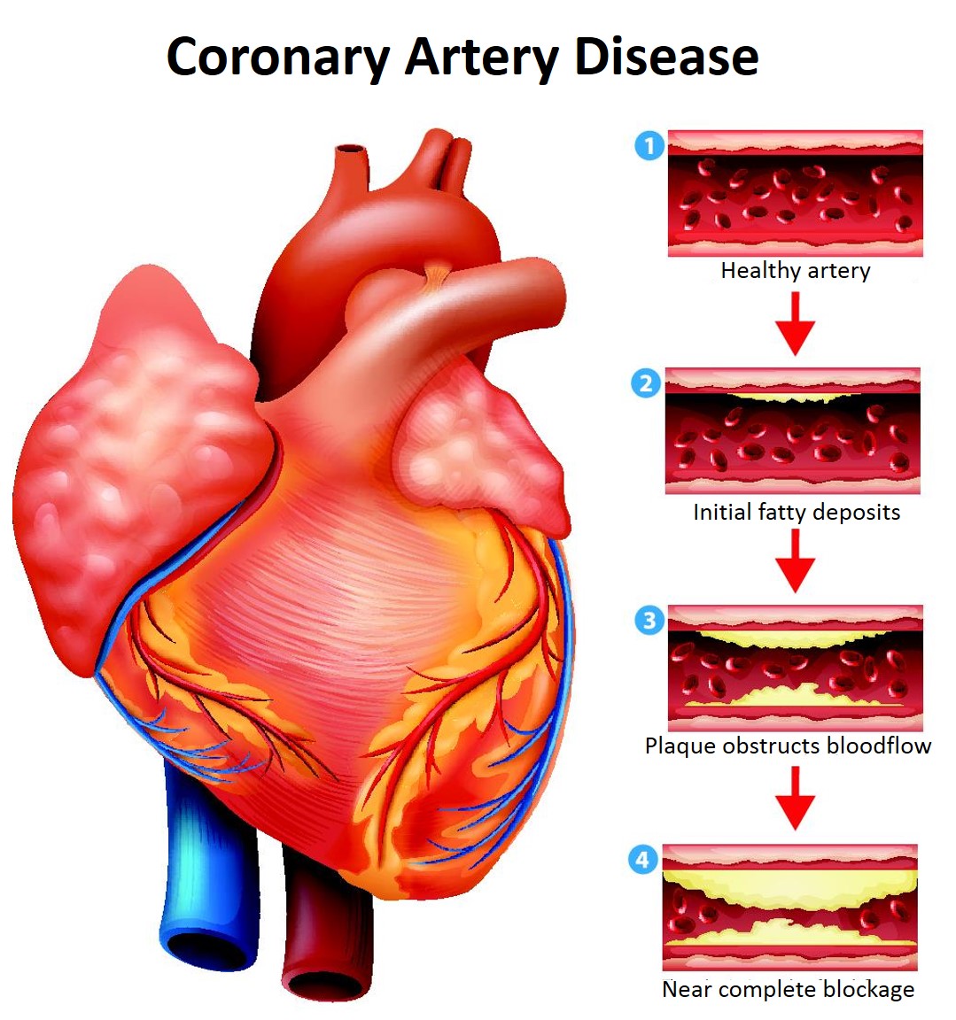 coronary-artery-disease.jpg