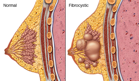 fibrocystic_breast_disease.png