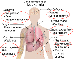 leukemia.png