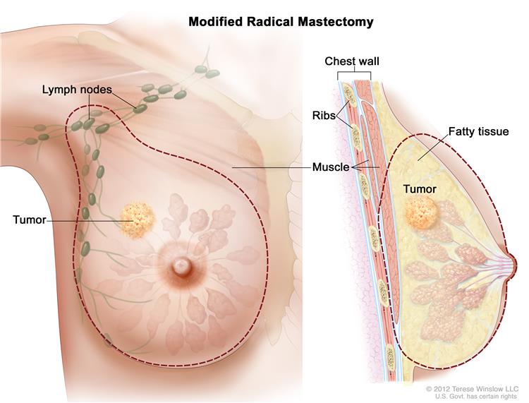 mastectomy_.jpg