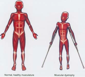 Figure 1: Showing the difference in muscle size in an individual without MD and an individual with MD.