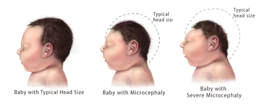 microcephaly_3.png