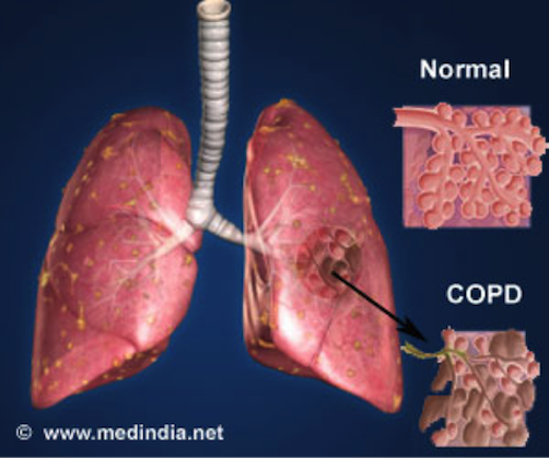 normal_and_copd_lung.png