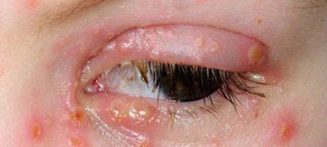 ocular-herpes-causes-symtoms-and-treatment-for-virus-eye-infection_470x212.jpg