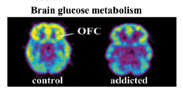 ofc_brain_glucose_metabolism.png