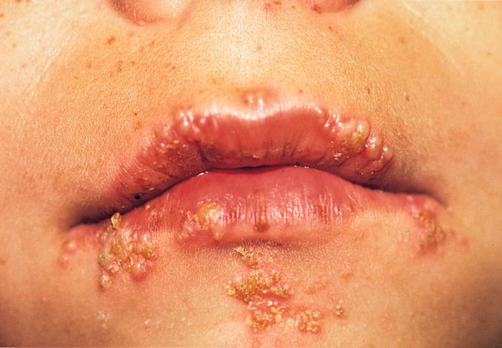 Figure —. Outbreak of herpes sores. (Baugher, 2009)