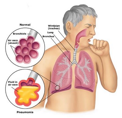 pneumonia_anatomy.jpg