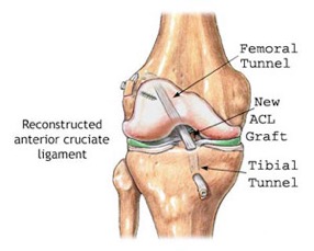 **Figure X:** Illustrates how the ACL is reconstructed and where the new graft is placed. 
 (Source: Tower Orthopaedics, 2016)