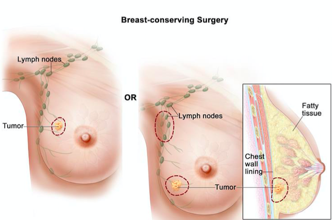 Are Breast Lumps Always a Cause for Concern?: Trevan Fischer, MD