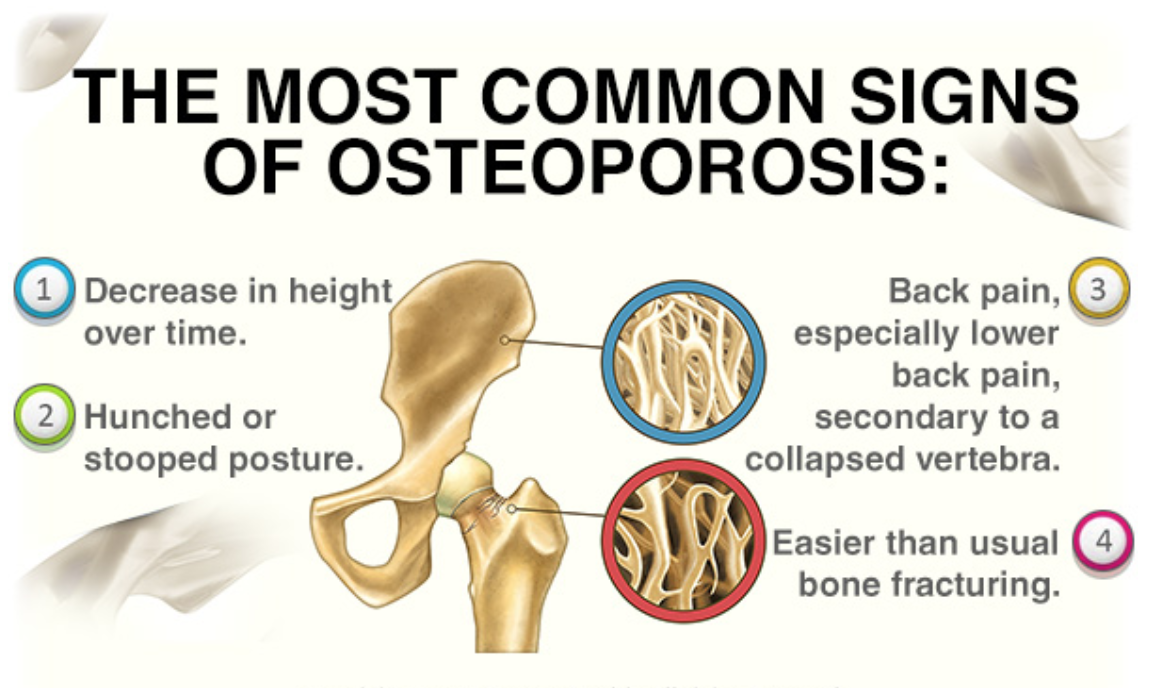 Osteoporosis alimentacion