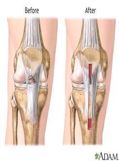 Figure X: Demonstrates the knee and ACL before and after surgery. (Source: A.D.A.M, 2013