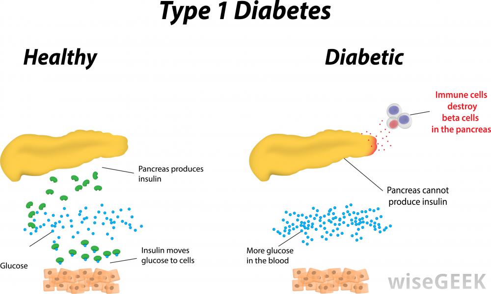type-1-diabetes-diagram.jpg
